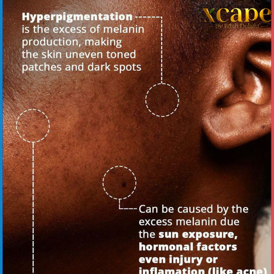 The Real Causes of Hyperpigmentation in Melanin-Rich Skin and How Xcape by Edith Delight Targets Them